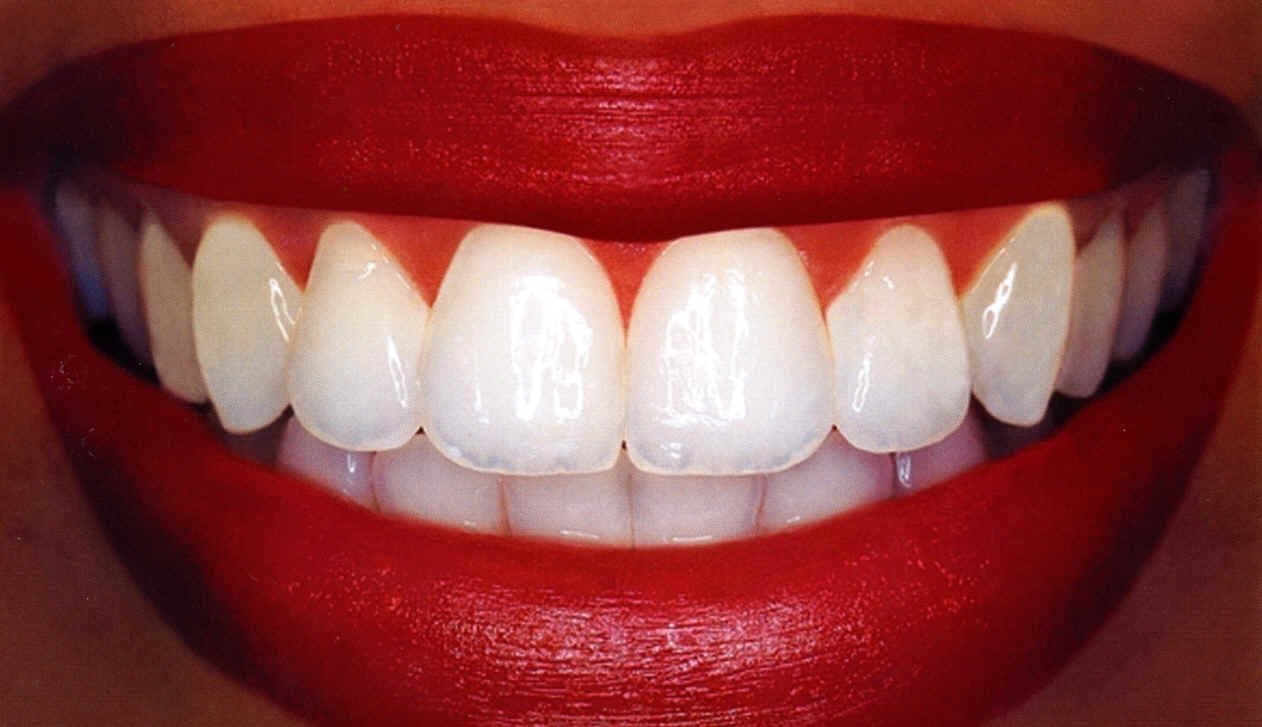 Professional teeth whitening procedures