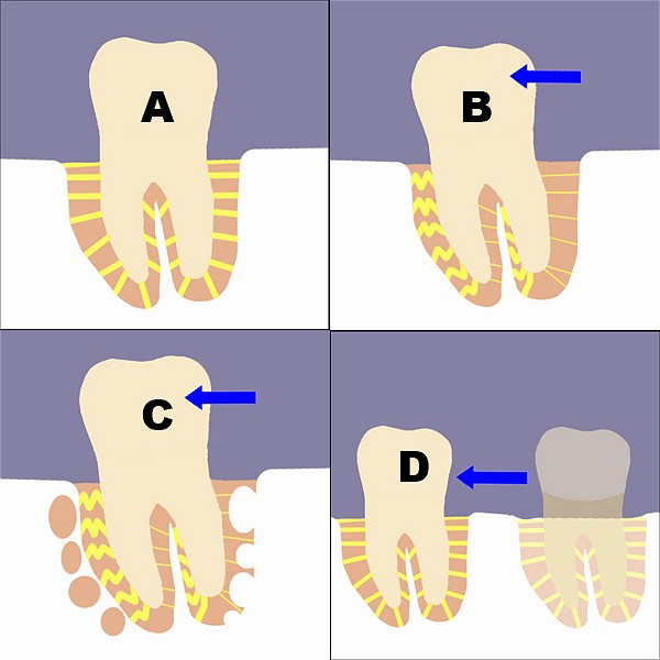 BIOLOGY OF TOOTH MOVEMENT : HOW DO BRACES WORK ?